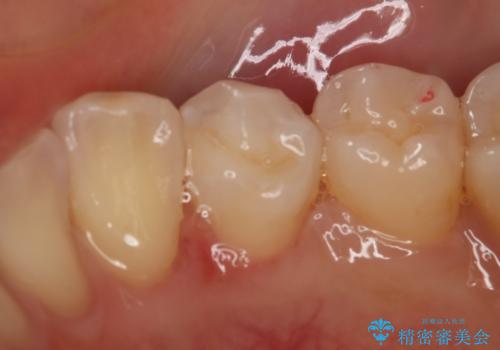 虫歯のところをセラミックで直したい セラミックインレーの治療後