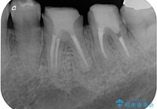 銀歯・虫歯・治療途中の歯を治していきたいの治療中
