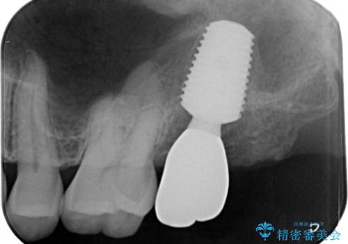 治療途中の虫歯の歯をインプラントにしたい インプラント治療の治療後