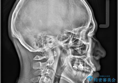 【マウスピース矯正】【インビザライン】前歯の凸凹を治したいの治療前