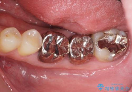 銀歯・虫歯・治療途中の歯を治していきたいの治療前