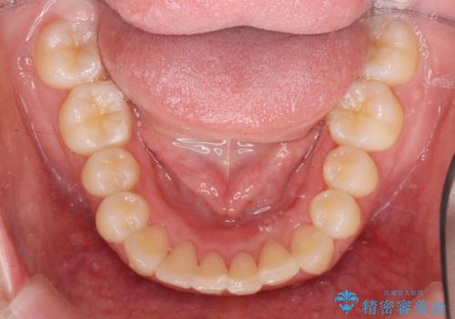 前歯のズレ・がたつき・すれ違いの矯正治療の治療後