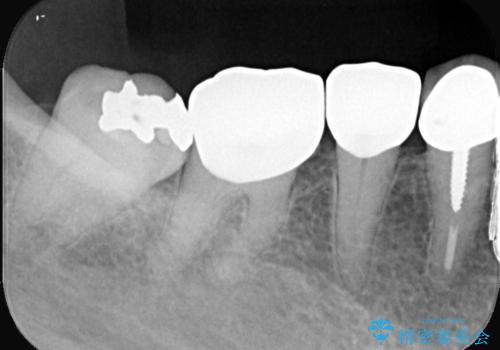 【セラミックインレー】笑うと銀の詰め物が目立つの治療前