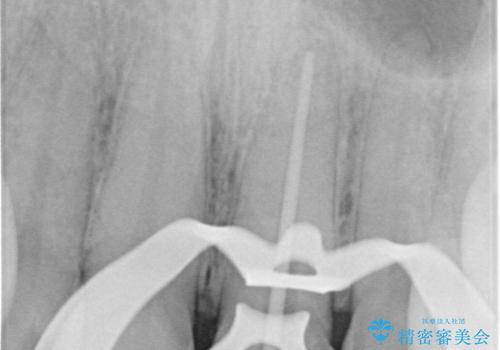 前歯の根のところに違和感がある|根尖性歯周炎|精密根管治療|オールセラミッククラウン|見た目も改善の治療中