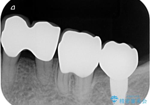 歯周病再生治療と歯周ポケット除去 歯周外科手術の治療後