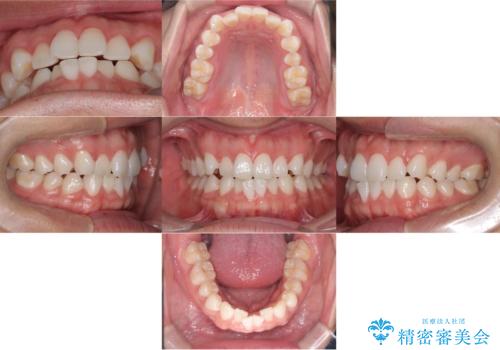 歯のデコボコを治したい|インビザラインで綺麗な歯並びに!|矯正期間は6ヵ月!の治療前