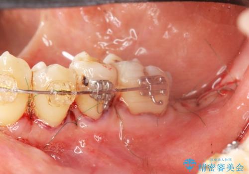 歯周病再生治療と歯周ポケット除去 歯周外科手術の治療前