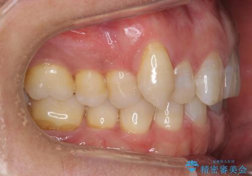 八重歯と下の歯のがたつき マウスピースでの治療前