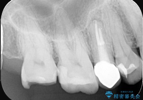 詰め物が欠けた 〈セラミッククラウン〉の治療前