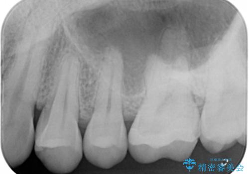 銀歯をやり変えたい セラミックインレーの治療後