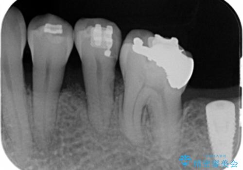 歯周病再生治療と歯周ポケット除去 歯周外科手術の治療前