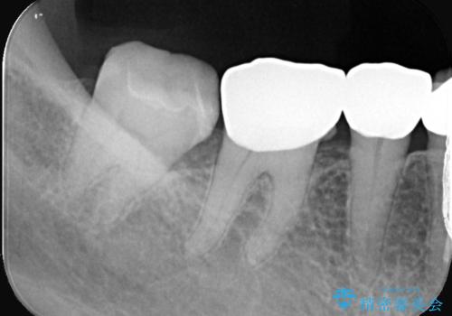 【セラミックインレー】笑うと銀の詰め物が目立つの治療後