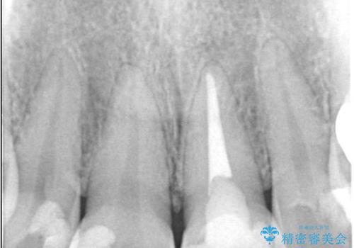 前歯の色が気になる!|オールセラミッククラウンの治療前