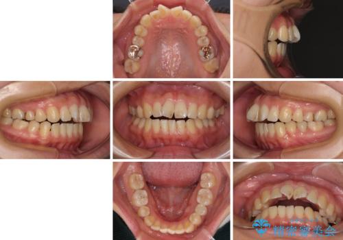 欠損と口元の突出感 ワイヤー装置での抜歯矯正の治療前