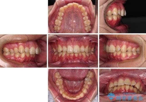 上顎前歯のデコボコを改善してスッキリした口元に ワイヤー装置での非抜歯矯正の治療前
