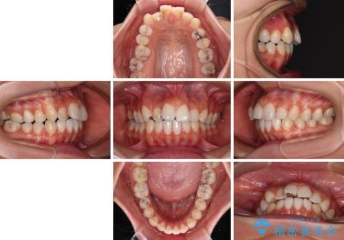 奥歯の咬み合わせのズレと前歯の突出感 変則的な抜歯矯正の治療前