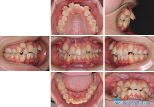 転位歯や埋伏歯などの難易度の高い抜歯矯正治療の治療前