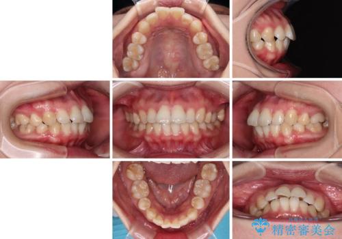 インビザライン・モデレートを用いて気になる後戻りを矯正治療の治療前