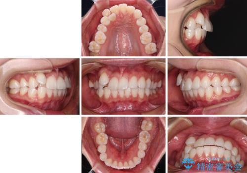 【モニター】八重歯と正中を改善 ワイヤー装置の抜歯矯正の治療前