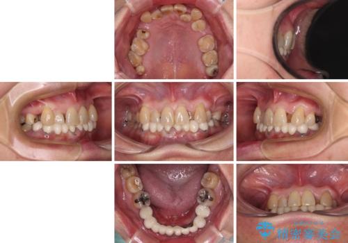 外れるブリッジと気になる八重歯 総合歯科治療で美しい口元にの治療前