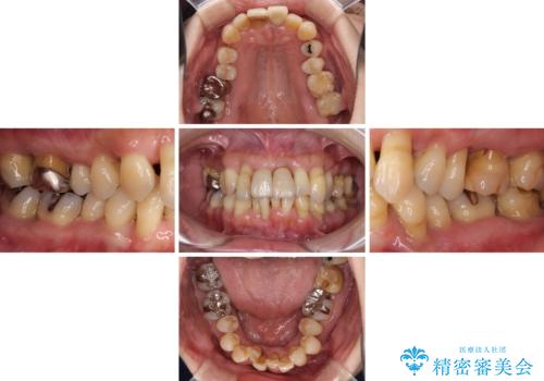 歯周病でグラグラの歯 矯正治療と歯周外科を併用した総合歯科治療の治療前
