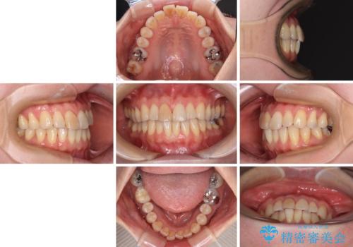 前歯のデコボコをインビザライン・モデレートで矯正治療の治療前