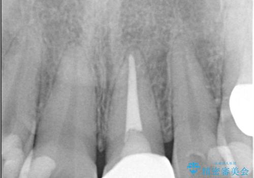 前歯の色が気になる!|オールセラミッククラウンの治療後