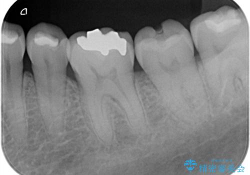 割れた奥歯をセラミックで修復の治療前