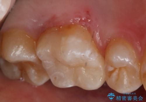 銀歯をやり変えたい セラミックインレーの治療後