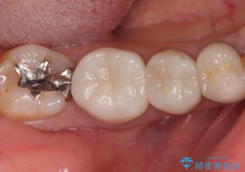 【セラミックインレー】笑うと銀の詰め物が目立つの治療前