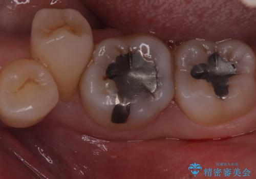 【セラミックインレー】口の中の銀の詰め物を白い物に替えたいの治療前