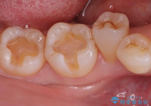 【セラミックインレー】口の中の銀の詰め物を白い物に替えたいの治療中