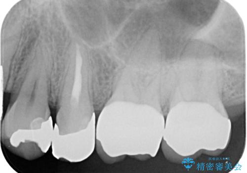 プラスチックの詰め物が外れた オールセラミッククラウンの治療後