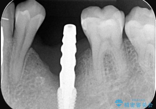 20年前にいれたインプラント|インプラント周囲炎|古いインプラントを除去しインプラント再埋入|痛く無いインプラント治療の治療中