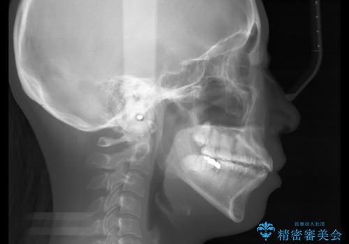 前歯を後ろに下げたい ワイヤー矯正(クリア装置)の治療前