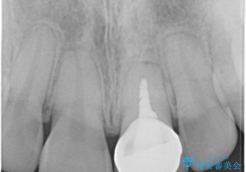 変色した歯をきれいにしたい セラミック治療の治療後