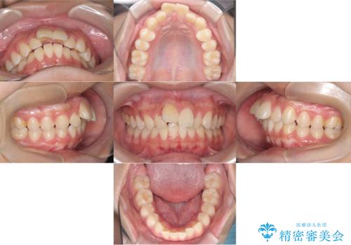 【ワイヤー矯正】前歯が出ているのが気になるの治療前
