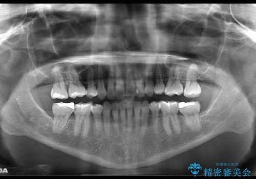 前歯を後ろに下げたい　ワイヤー矯正(クリア装置)の治療後