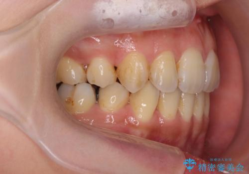 八重歯を矯正治療で治したい!の治療後