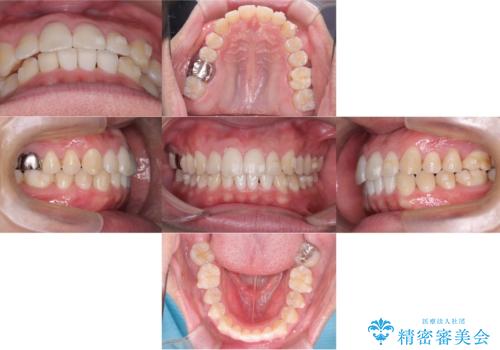 【マウスピース矯正】【インビザライン】前歯の凸凹を治したいの治療中