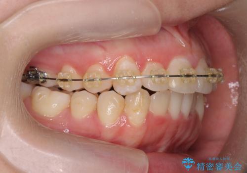 前歯のズレ・がたつき・すれ違いの矯正治療の治療中