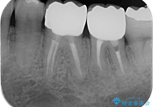 銀歯・虫歯・治療途中の歯を治していきたいの治療後