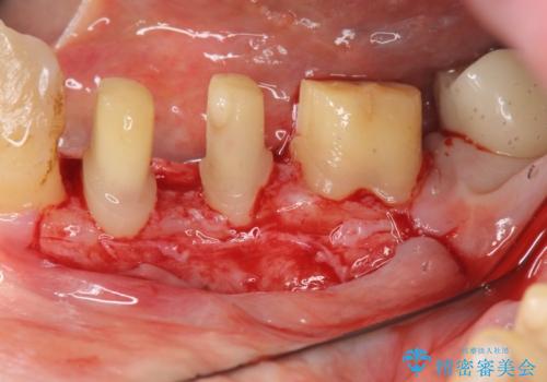 歯周病再生治療と歯周ポケット除去 歯周外科手術の治療中