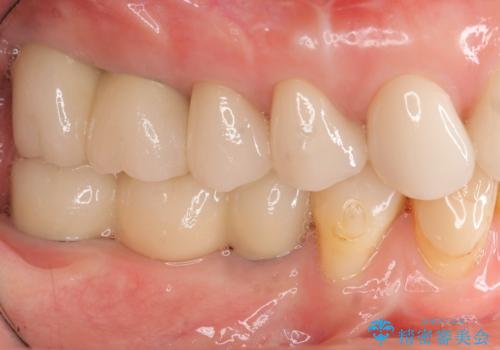 全顎 虫歯 インプラント治療の治療後