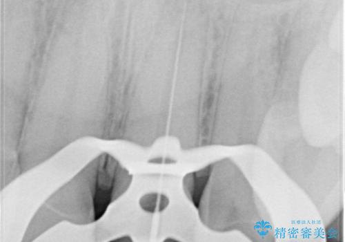前歯の根のところに違和感がある|根尖性歯周炎|精密根管治療|オールセラミッククラウン|見た目も改善の治療中