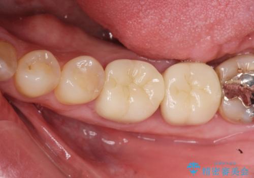 銀歯・虫歯・治療途中の歯を治していきたいの治療後