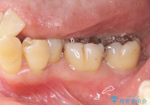 歯周病再生治療と歯周ポケット除去  歯周外科手術の症例 治療前