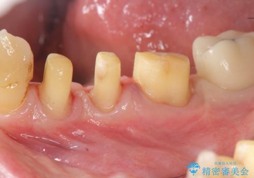 歯周病再生治療と歯周ポケット除去 歯周外科手術の治療中