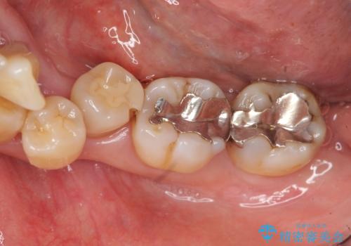 歯周病再生治療と歯周ポケット除去 歯周外科手術の治療前
