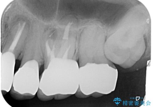 銀歯・虫歯・治療途中の歯を治していきたいの治療後